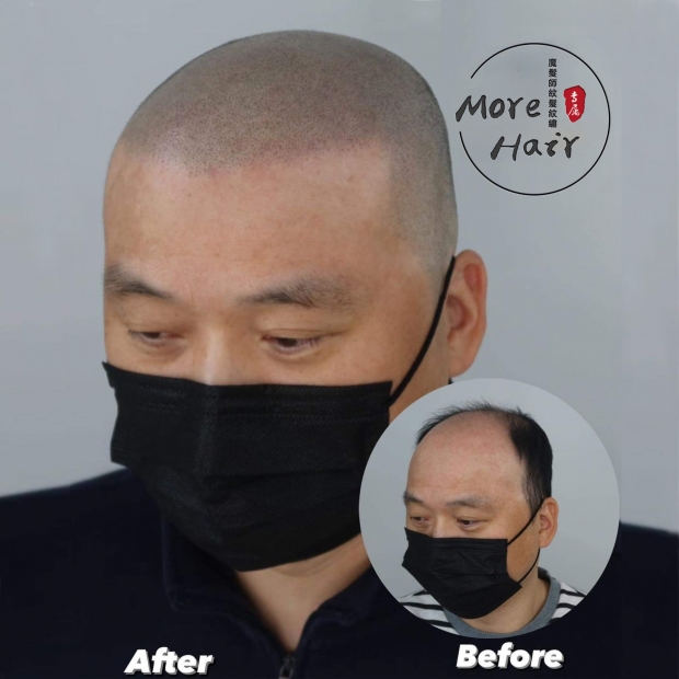 morehair_showcase_male-hairline-7 下午5.20.11.jpg