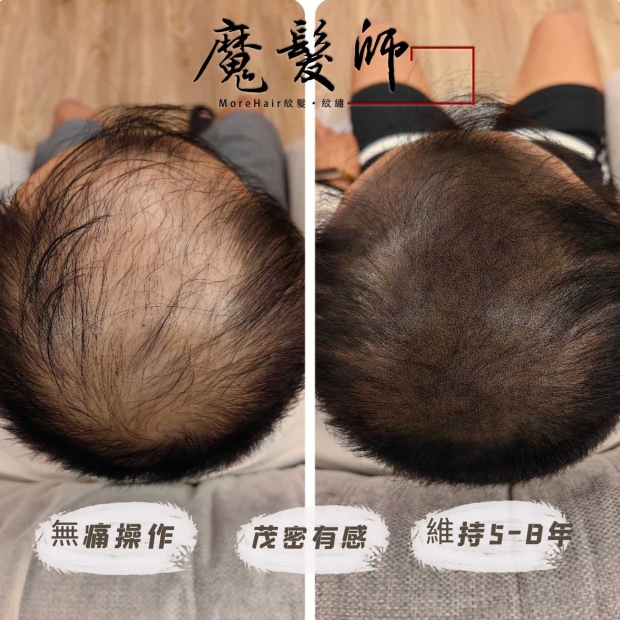 morehair_showcase_male-hairline-8.jpg