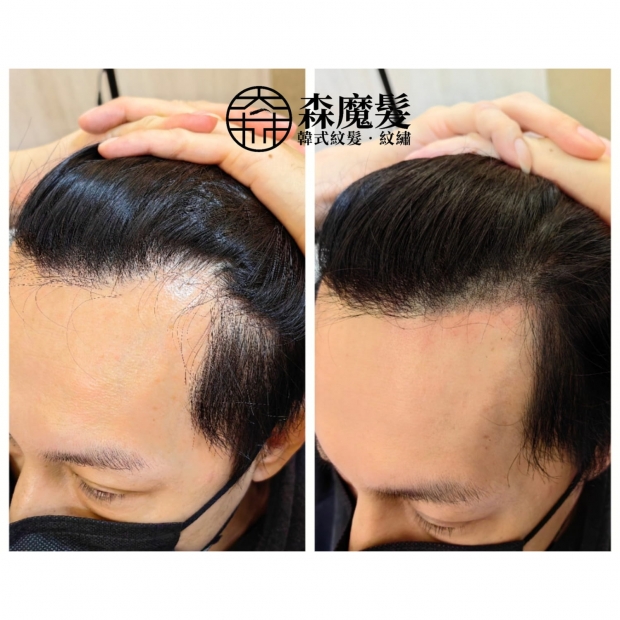 morehair_showcase_male-hairline-9.jpg