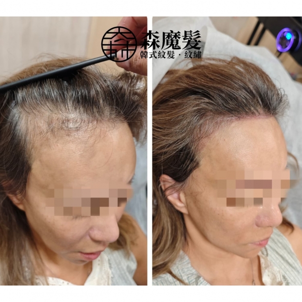 morehair_showcase_female-hairline-8.jpg